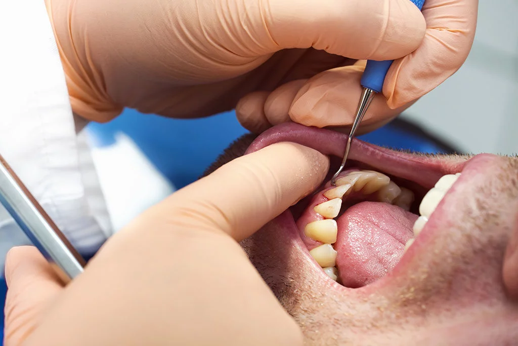 🧬 What Are Oral Bacteria?