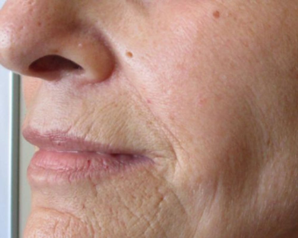 Can Laser Genesis Be Used for Anti-Aging Treatments?