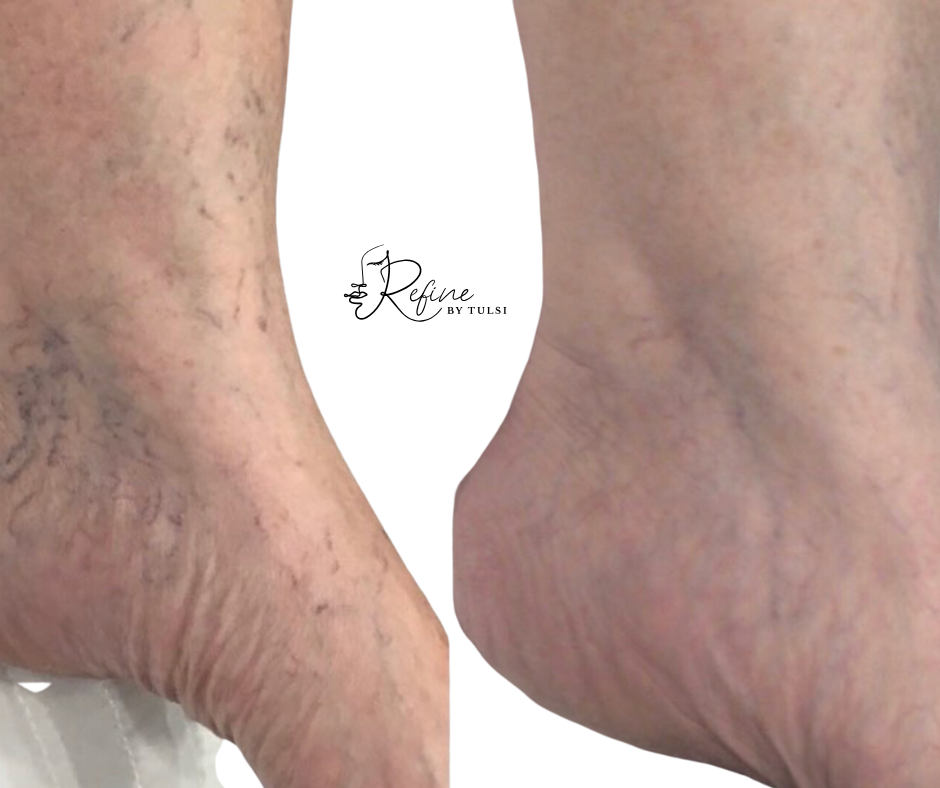 Effective Methods for Spider Vein Removal