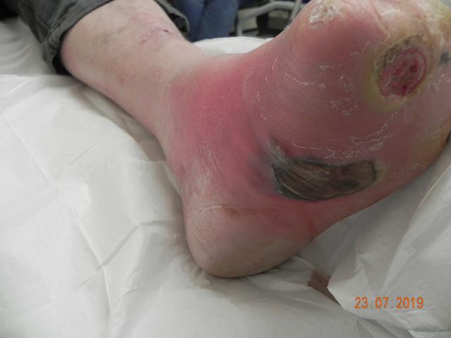 How Diabetic Foot Care Differs from General Foot Care