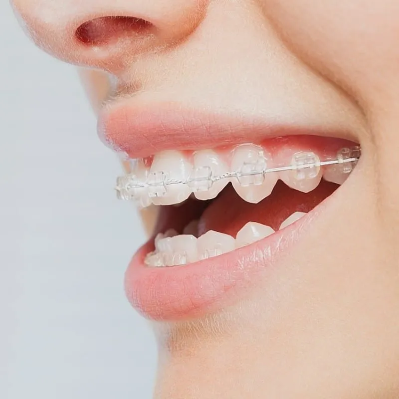 How Invisalign Improves Both Aesthetic and Functional Concerns