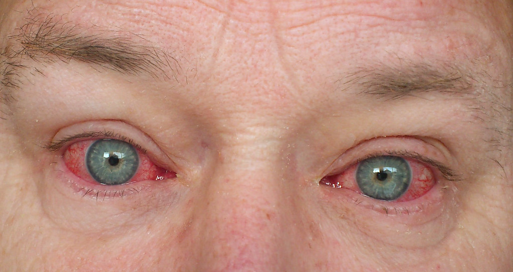 How Lifestyle Choices Can Contribute to Red Eyes