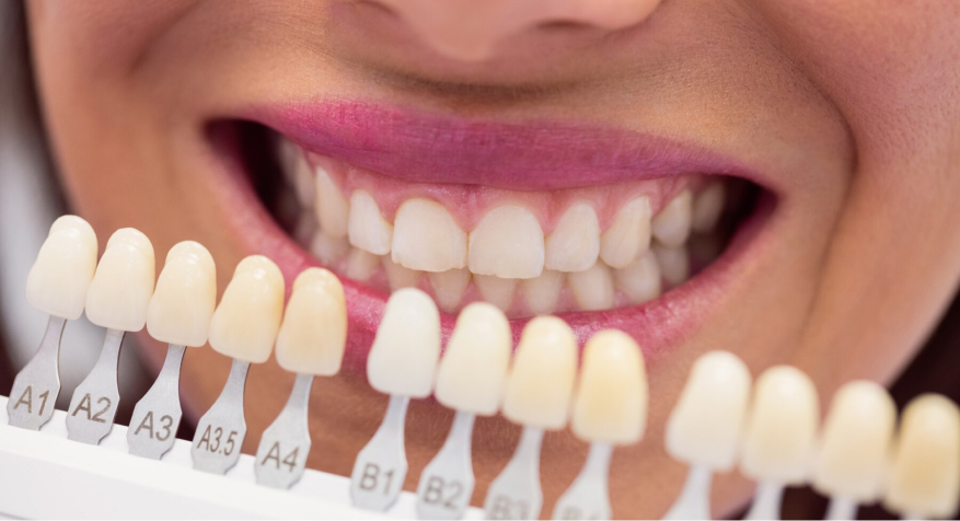 How To Choose Between Dental Implants and Veneers