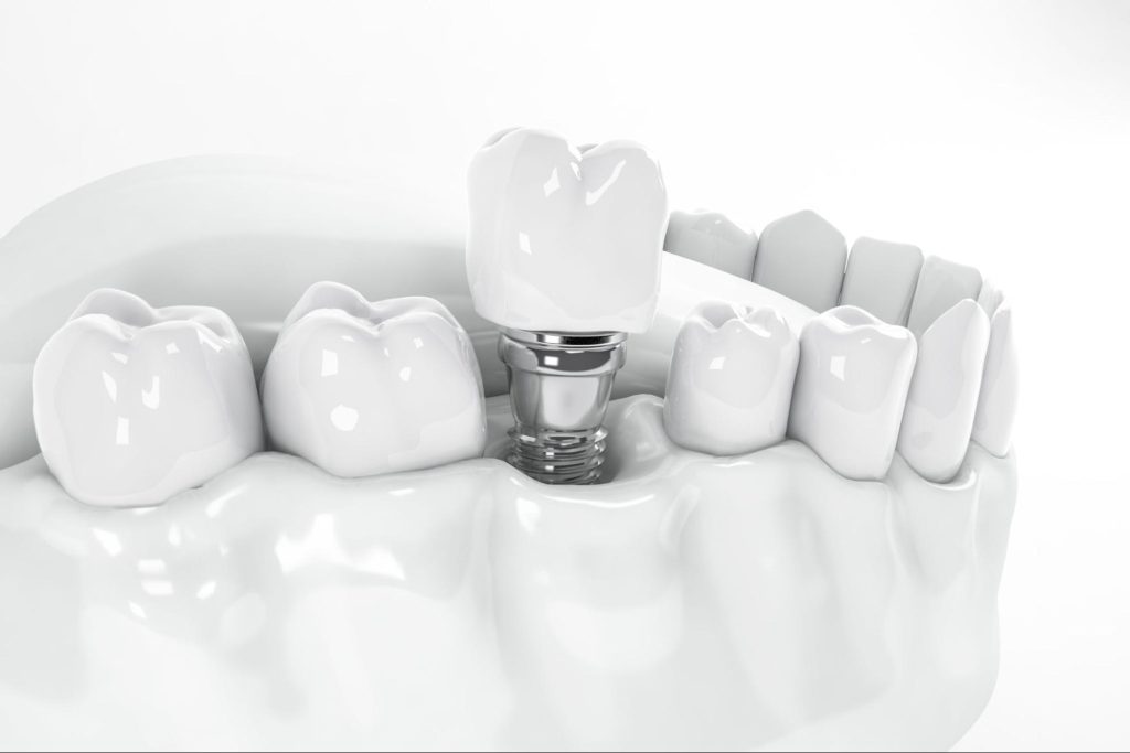 How a Dental Implant Specialist Can Help You Achieve a Natural-Looking Smile