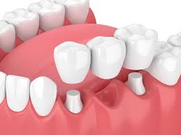 How to Care for Your Dental Bridges for Optimal Longevity