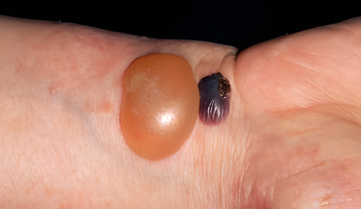 Key Differences Between Warts on Adults and Children