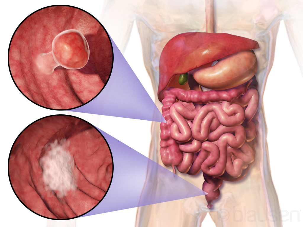 Proctology vs. Colorectal Surgery