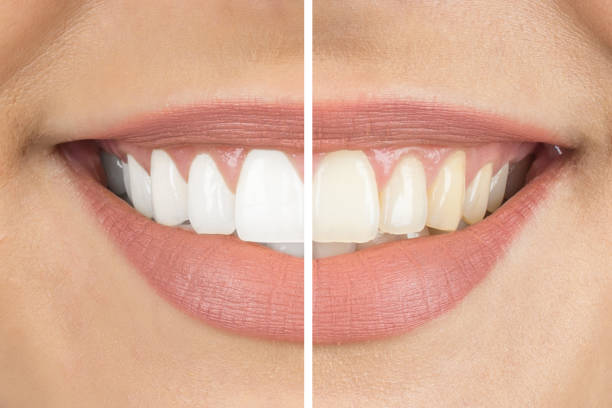 Reasons To Get Professional Teeth Whitening