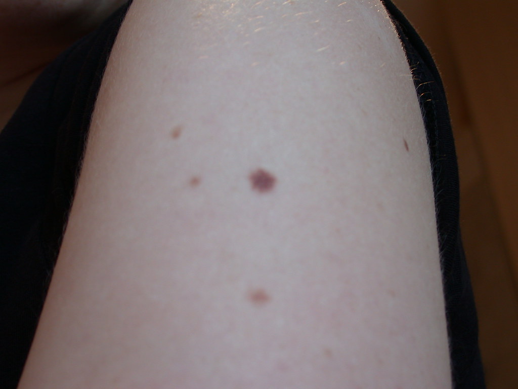 Reasons to Have Moles Removed