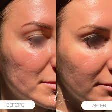 Remedies for Relieving Mild Skin Rashes