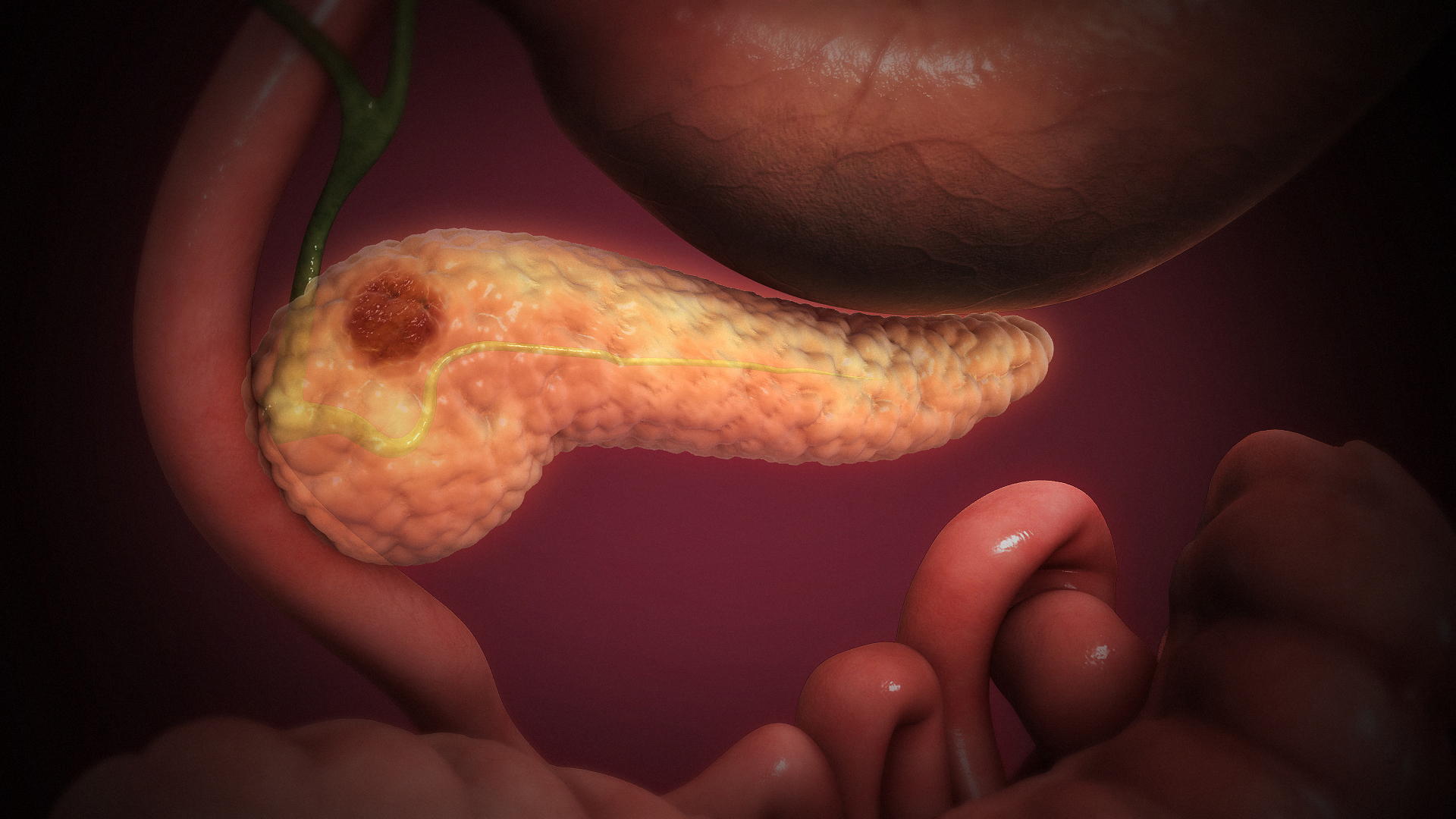 The Connection Between Pancreatic Cancer and Diabetes