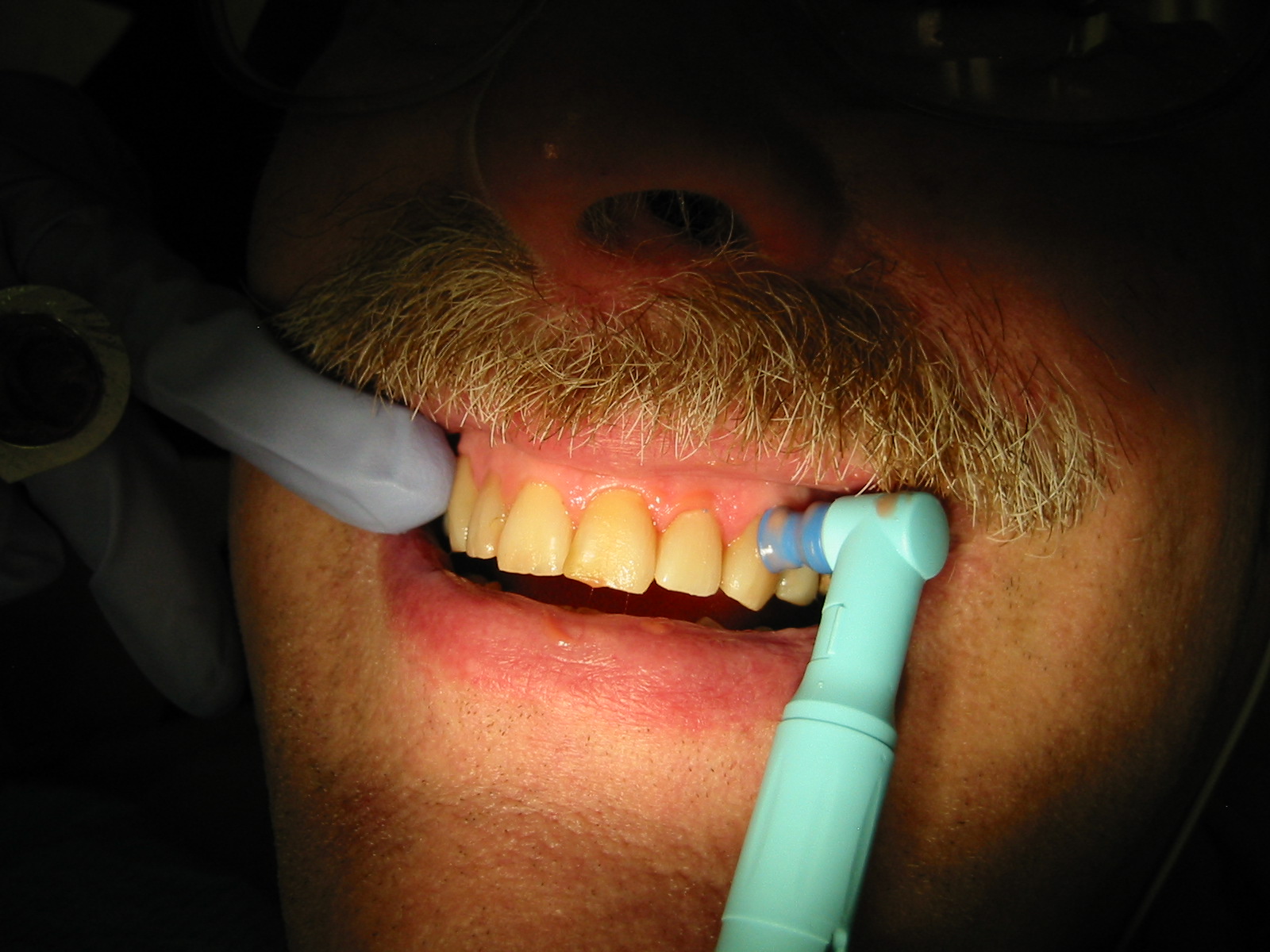 The Evolution of Teeth Cleaning Tools: A Historical Overview