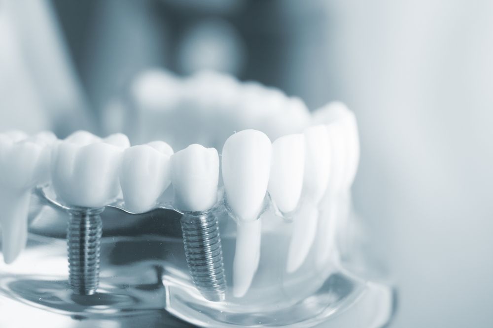 The Process of Getting Dental Implants