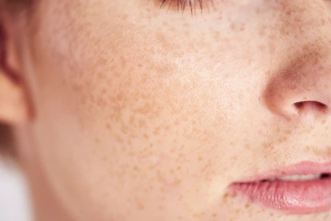 The Role Dermatologists Play in Managing Eczema