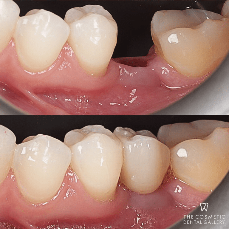 What Are Cosmetic Dental Implants?