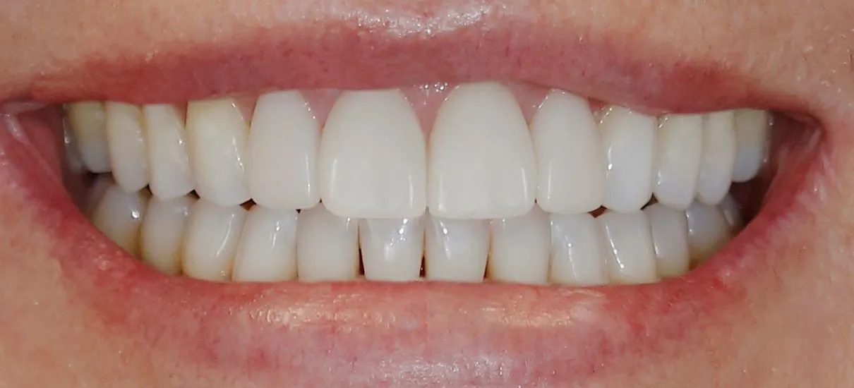What Are Veneers in Cosmetic Dentistry?