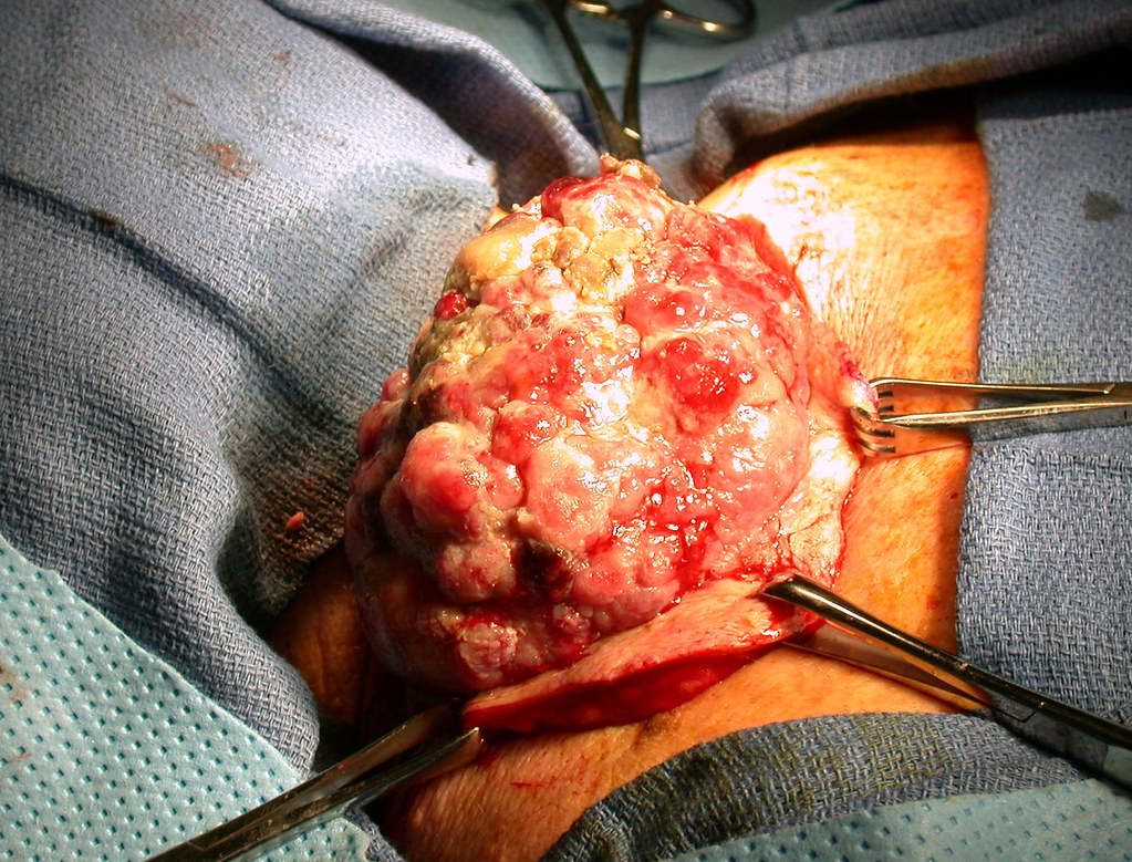 What You Need To Know About Mohs Surgery for Melanoma