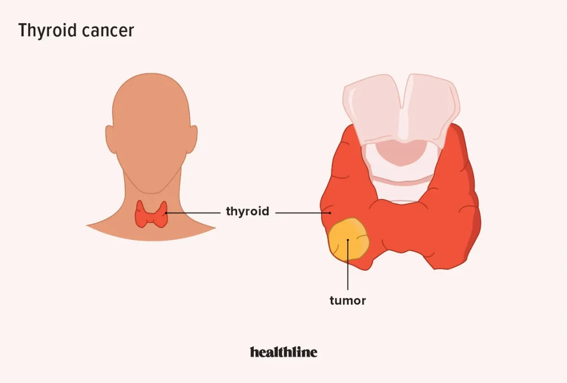 What You Need to Know About the Risks of Thyroid Surgery