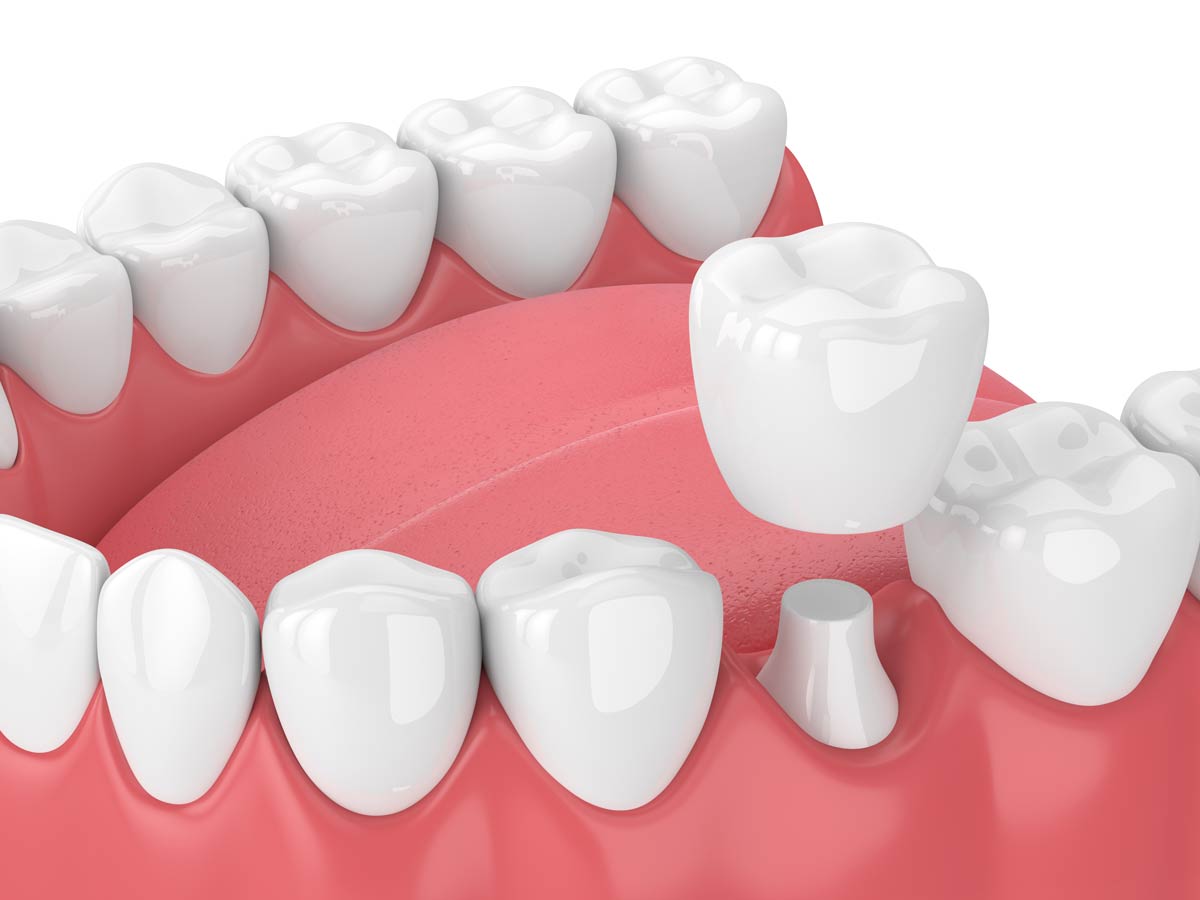 What to Expect During a Dental Crown Procedure