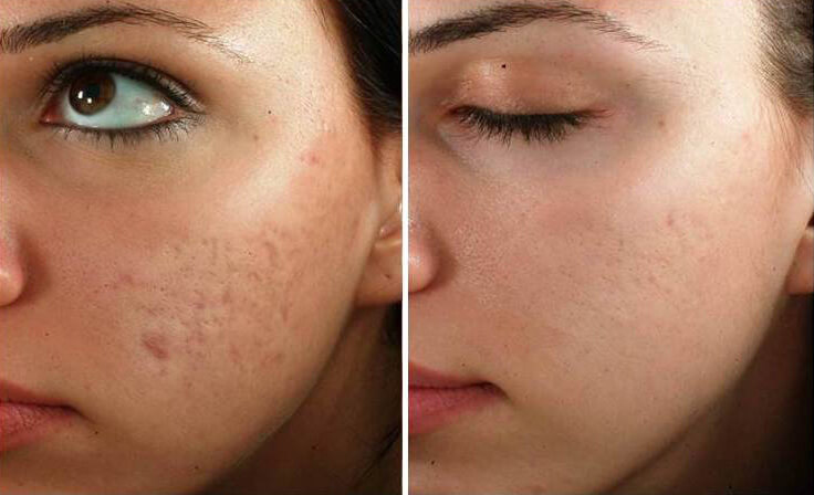 What to Expect from a Microneedling Session