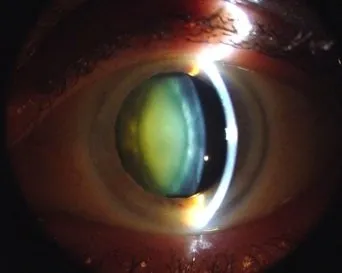 When Should You See an Ophthalmologist for Age-Related Eye Issues?