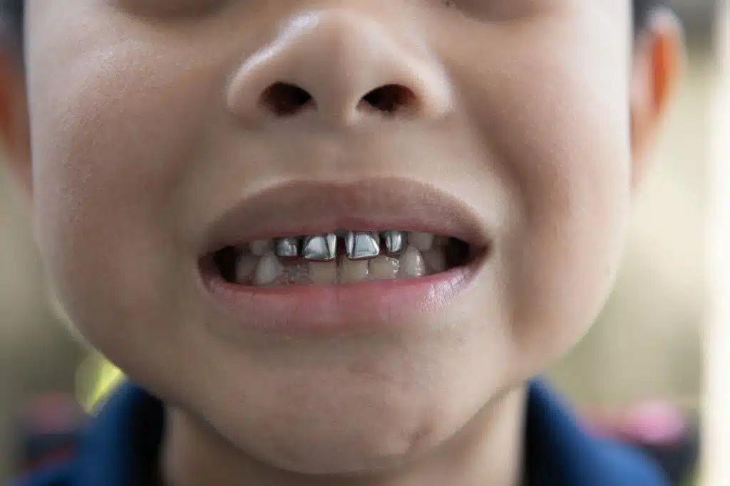 When You Should Consider Getting Crowns for Your Teeth