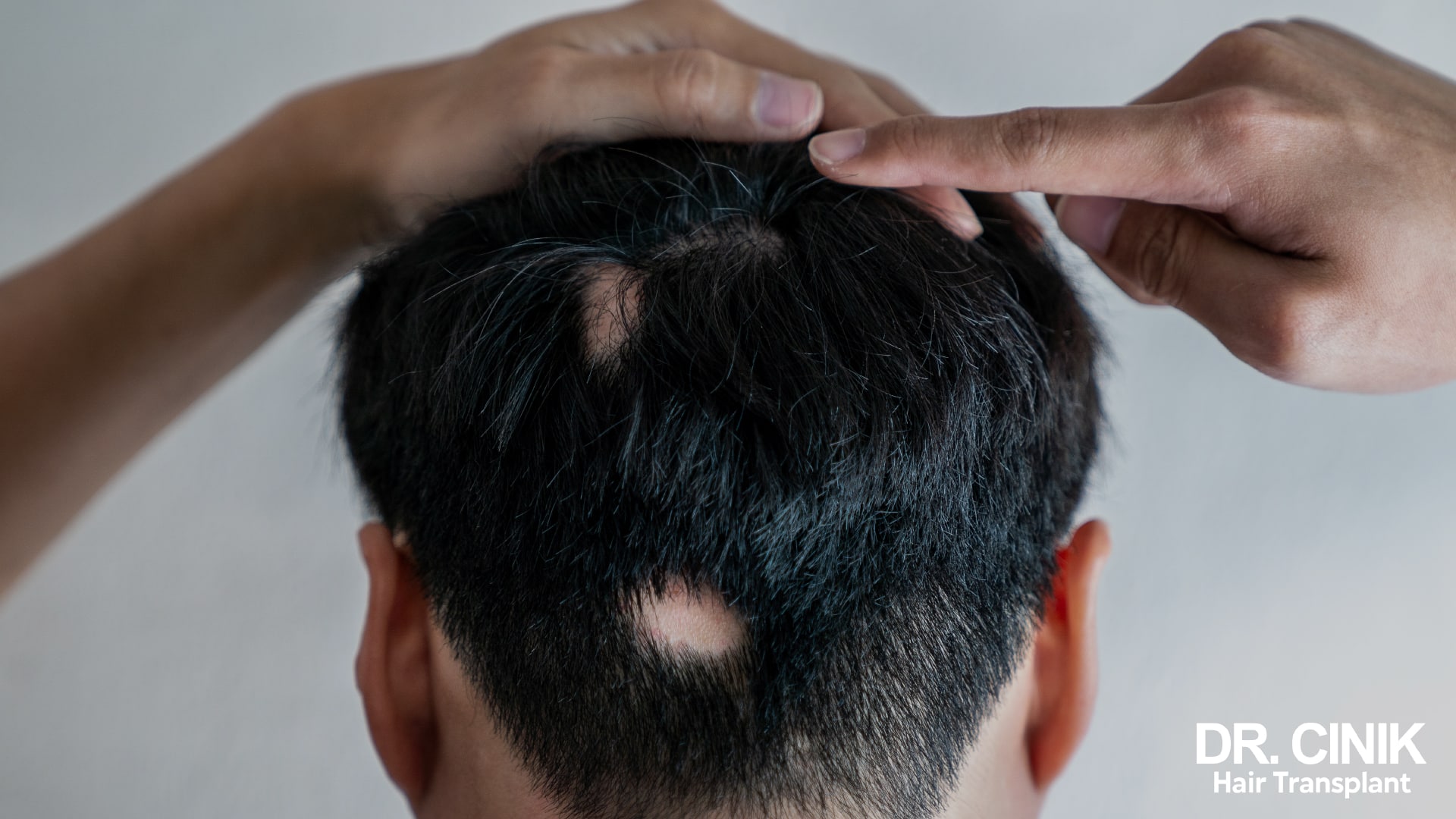 3 Causes and Treatments for Hair Loss