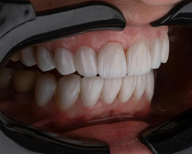 How Can Endodontics Heal My Tooth Tissue?