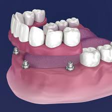 How Dental Implants Work