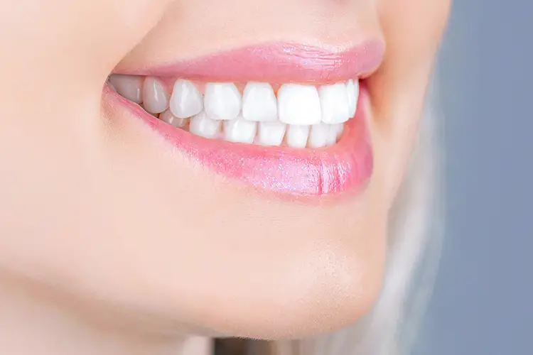 Professional vs DIY Teeth Whitening