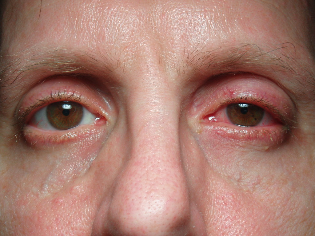 The Connection Between Sinus Infections and Sinus Pressure