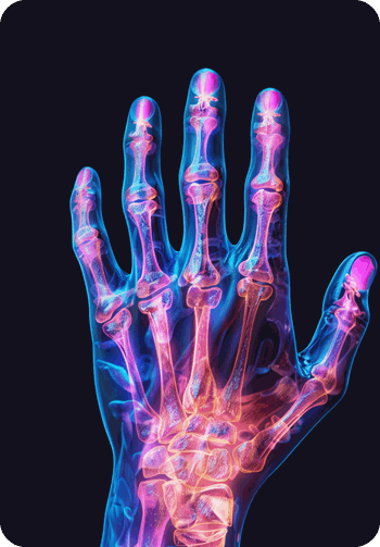 Why Gout Is More Common in Certain Individuals and How to Reduce the Risk